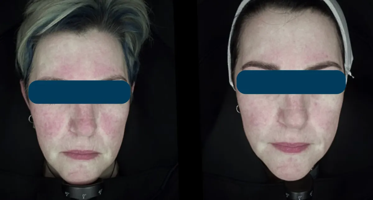 Unmasking Redness – Simple Ways to Calm It