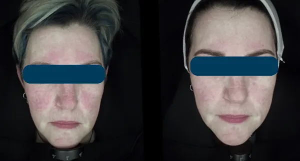 Unmasking Redness – Simple Ways to Calm It